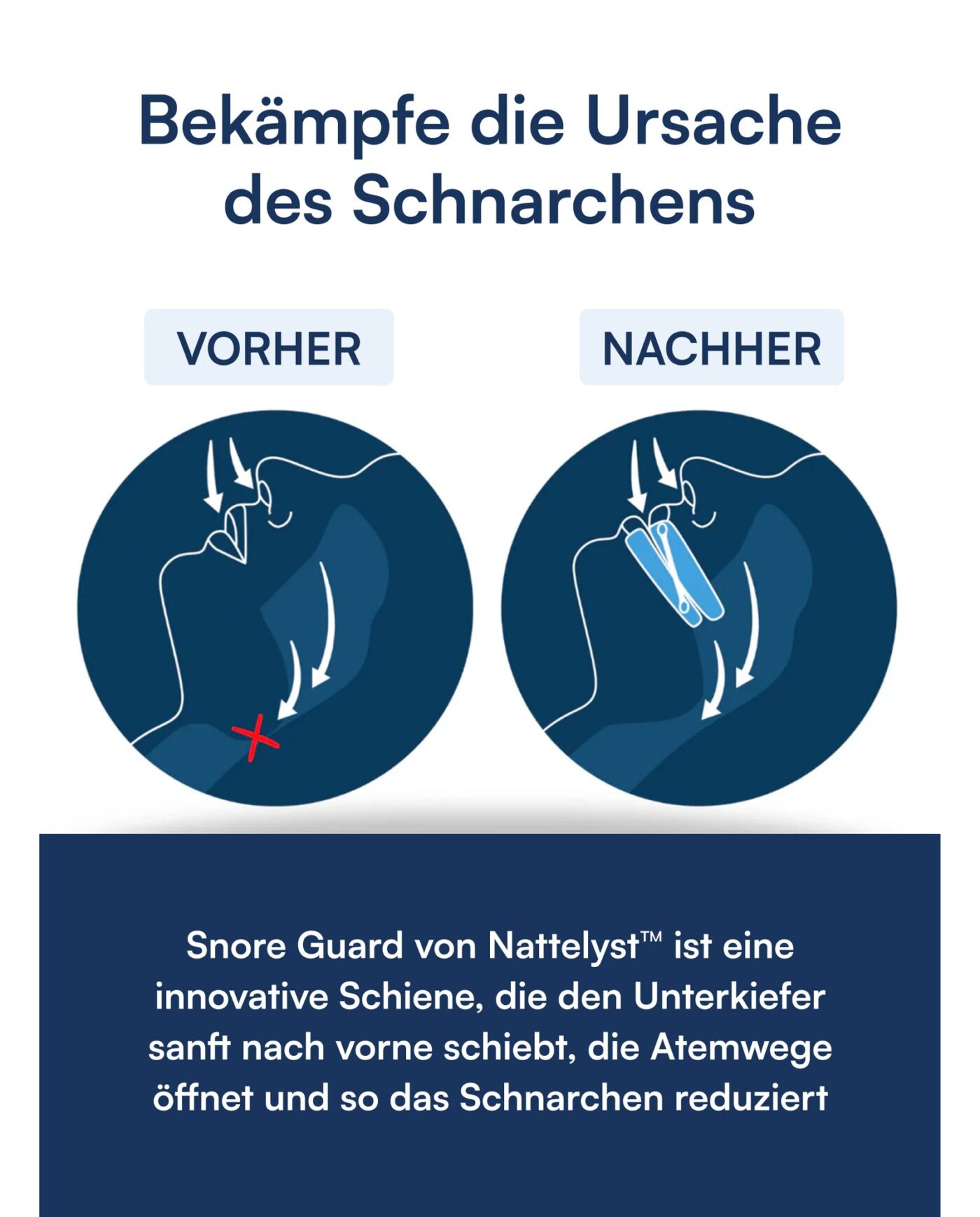 Snore Guard Schnarchschiene